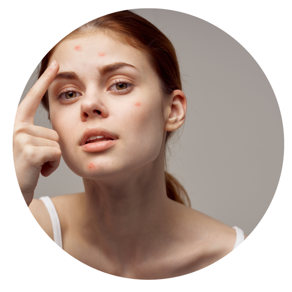 Frau mit Pickeln im Gesicht als Sinnbild für Hautprobleme welche mit Hilfe von Ayurveda Beratungen behandelt werden können.
